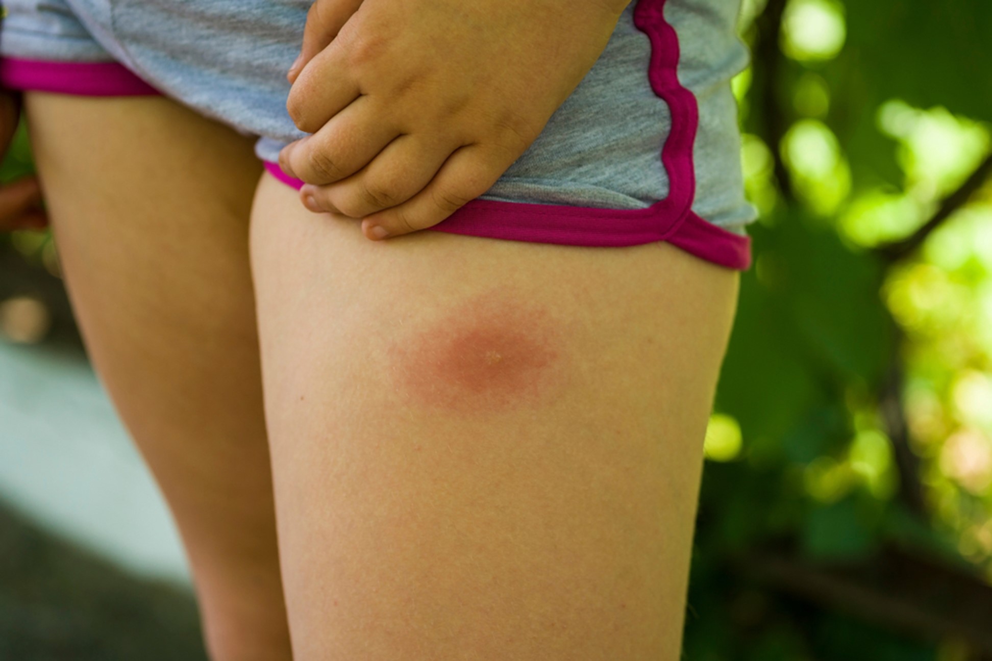 A closeup image of a tick bite on the leg of a young girl.